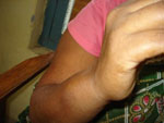 Ms. Pun's swollen right hand. Ms. Pun's swollen right hand.
