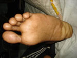 Left sole where blue and red marks were observed. Left sole where blue and red marks were observed.